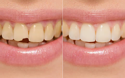 Cosmetic Bonding